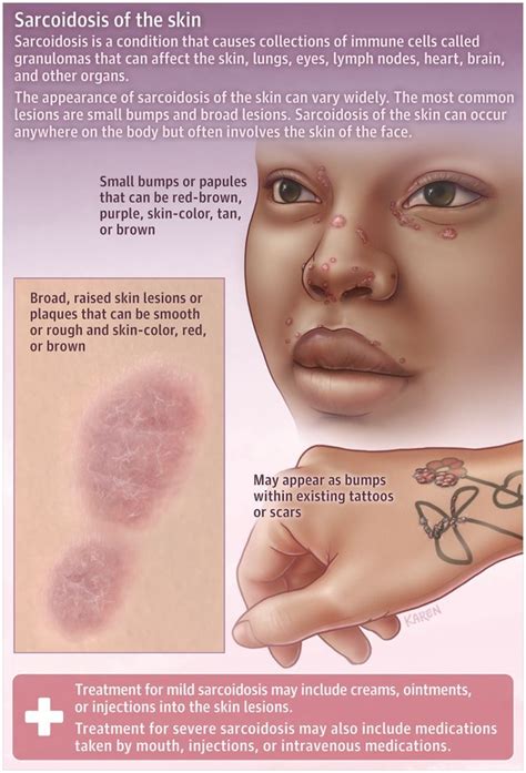 Basal Cell Carcinoma Artofit