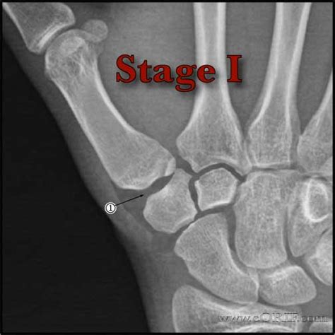 Thumb Basilar Joint Arthritis Classification Eorif