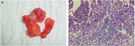 Rbcp Radioguided Sentinel Lymph Node On Surgical Treatment Of