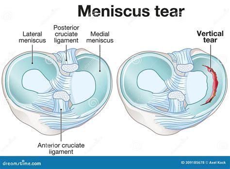 Meniscus Tears Anatomy Medically Illustration Stock Photography