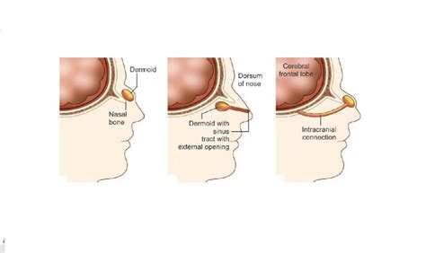 What Is Dermoid Cyst On The Nose Dr Sharad Ent Specialist