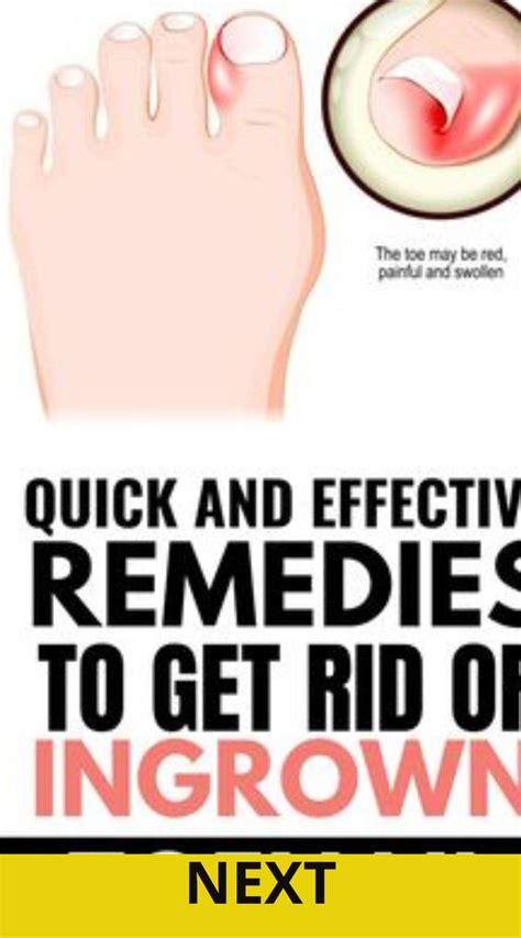 How to get rid of painful toenails without a doctor