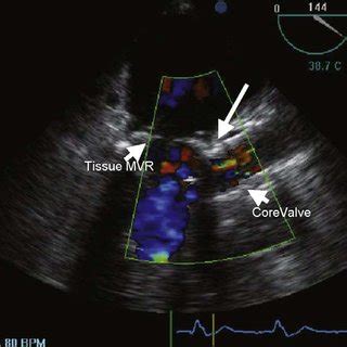 transesophageal echocardiography mid esophageal long axis view arrow