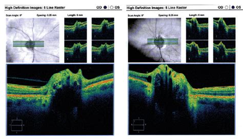 Tomographie par cohérence optique montrant l irrégularité de la surface