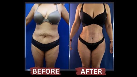 Body Transformation After Hourglass Tummy Tuck And AB Etching Dr