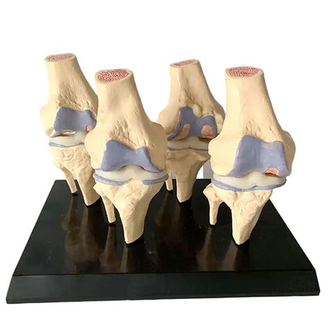 Buy Knee Joint Model Set 4 Stage Human Knee Joint Comparison Model