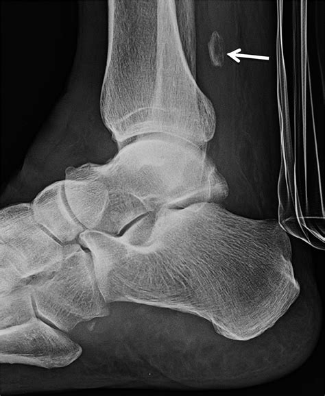 Lateral Radiograph Of The Right Ankle Obtained In January 2017 Download Scientific Diagram