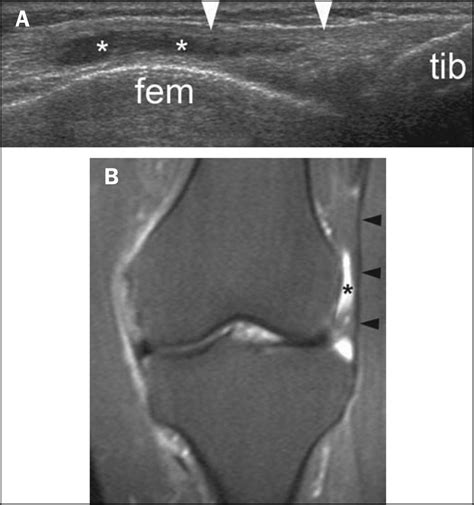 Iliotibial Band Syndrome Ultrasound