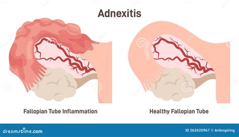 Salpingitis Or Adnexitis Infection And Inflammation In The Fallopian Tube Stock Vector