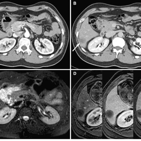 A 26 Year Old Man With Multifocal Nodular Type Hepatic Epithelioid