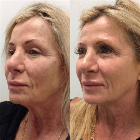 Aesthetic Injectables Pdo Thread Lift Beautysmart Medica Erofound