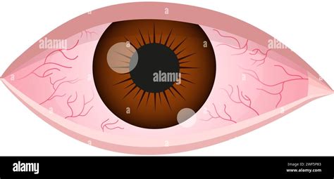 Dry Eye Syndrome Inflamed Bloodshot Eyeball With Swelling Irritation