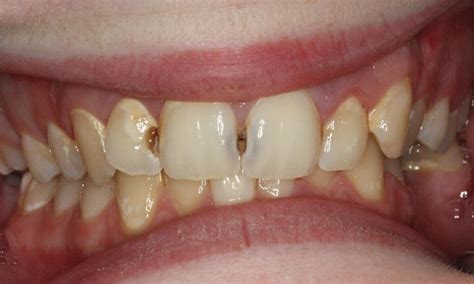 Anterior White Fillings Before And After Photos Lead Sd