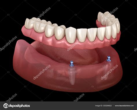 Prótese Removível Mandibular Tudo Sistema Suportado Por Implantes