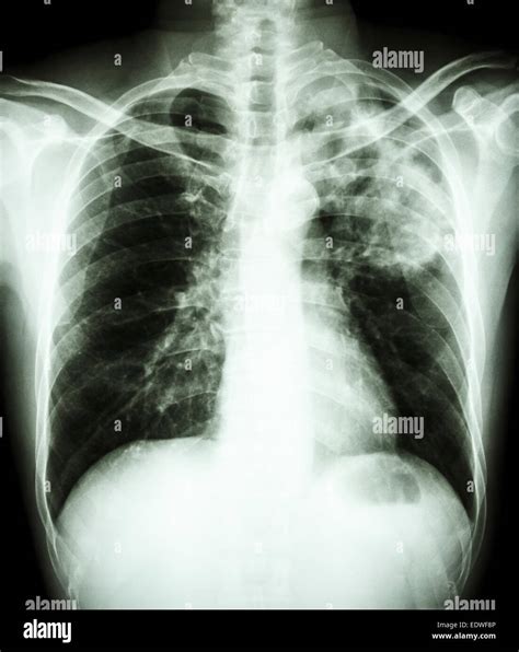 Film Chest X Ray Show Alveolar Infiltrate At Left Upper Lung Due To Mycobacterium Tuberculosis