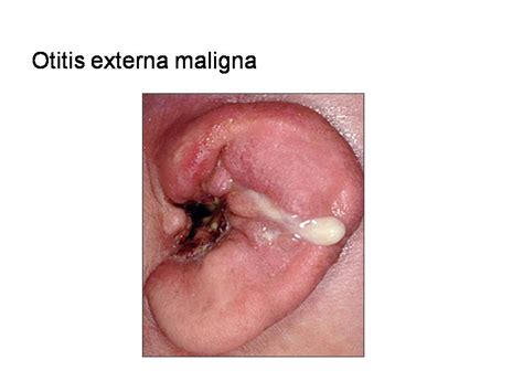 Otitis Externa Aguda Otitis Externa Aguda Difusa Del Conducto The