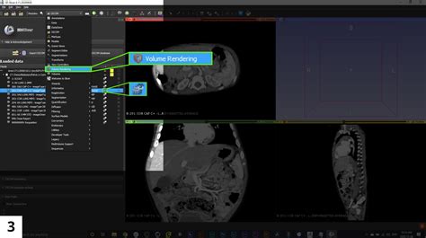 Tutorial 3d Reconstructions Using 3d Slicer Tvasurg The Toronto Video Atlas Of Surgery