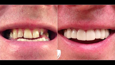 Veneers Before And After | Brighter Image Lab Gallery [2020]