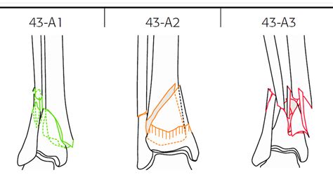 Type A Fracture Classification For Distal Tibia Fractures Download Scientific Diagram