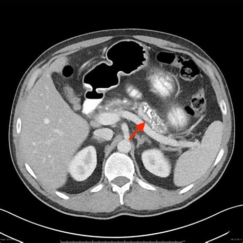 Malabsorption Syndrome Gastrointestinal Medbullets Step 1