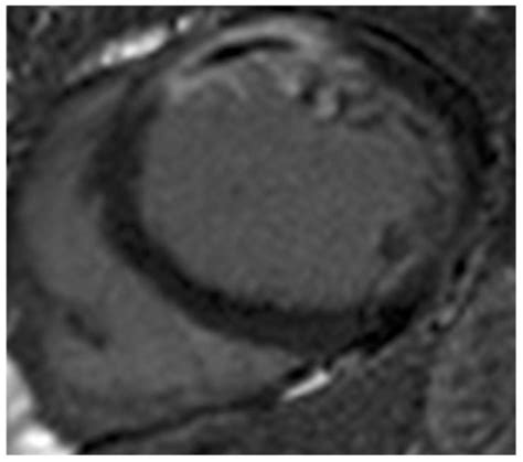 Microvascular Obstruction in Acute Myocardial Infarction, a Potential ... 