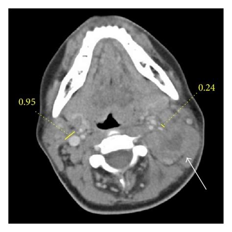 Computed Tomography Scan Of The Neck Without Contrast Showing Enlarged