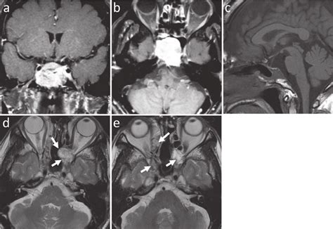 Case A B Preoperative Enhanced Coronal A And Axial B Mri