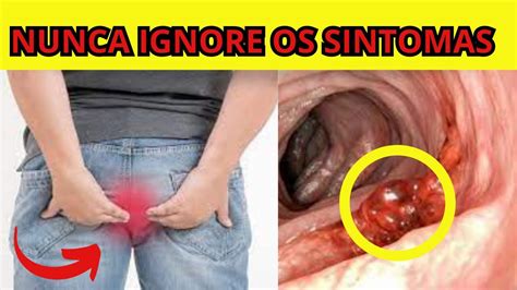 Nunca Ignore Os Sinais Como Identificar Os Sintomas Do C Ncer De