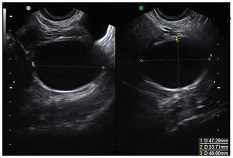 Ovarian Cyst On Ultrasound Image