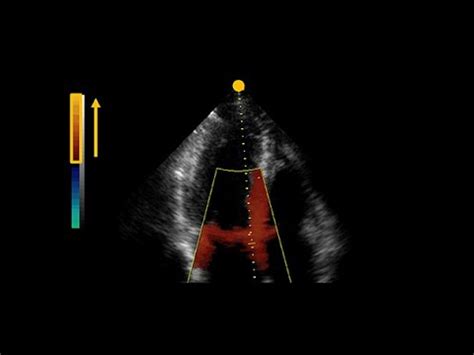 What Is Tissue Doppler And Speckle Tracking In Echocardiography YouTube