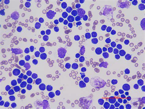 Diagnostic testing in cases of leukocytosis