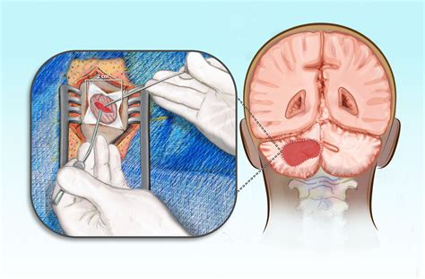 Right Panel Coronal View Of Large Spontaneous Cerebellar Hemorrhage