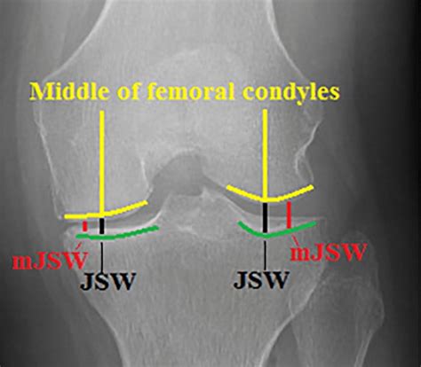 Radiographic Measurement Technique Of Jsw And Mjsw Of Both Rosenberg