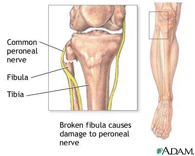 Common peroneal nerve dysfunction | UF Health, University of Florida Health