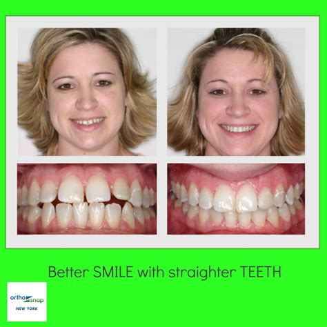 Clear Braces Orthosnap As Effective As Traditional Braces Invisible