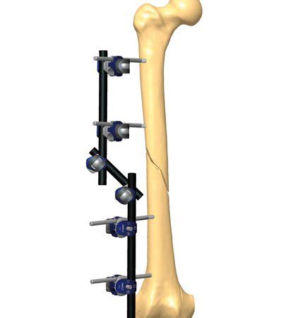 Femur Fracture Recovery Orthofix Abs