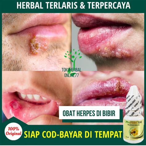 Herpes Di Bibir Newstempo