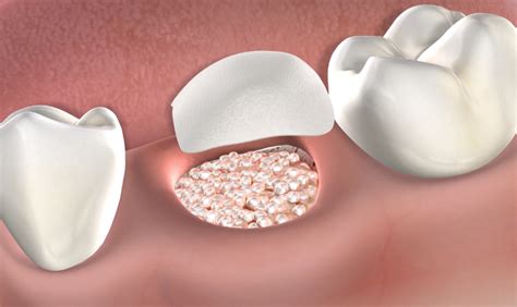 Understanding The Healing Process Of Dental Bone Grafts Dentist In City