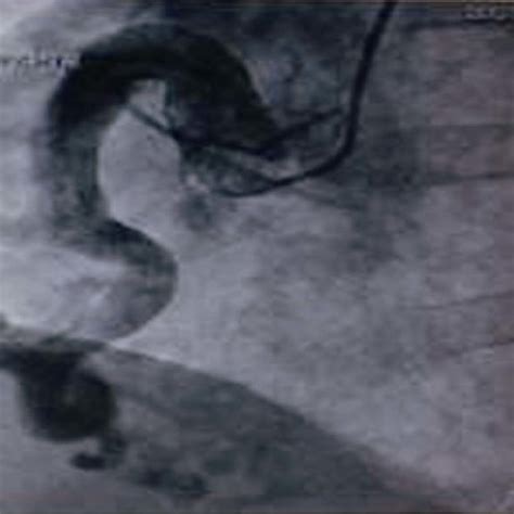 segmental ectasia    coronary artery coexisting stenosis