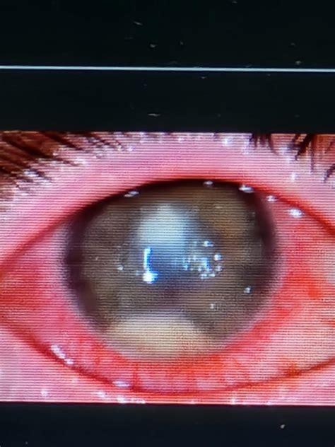 My eye with fungal infection 3 days before emergency cornea transplant ...