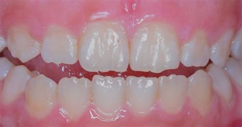 Mamelon Teeth: Why You Have Ridges on Your Teeth | The Healthy