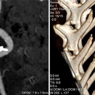 Computed Tomographic Angiography Study Left Contrast Enhanced