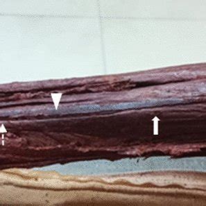 Axial T1W TSE MR Image Of The Wrist M Flexor Carpi Radialis Tendon