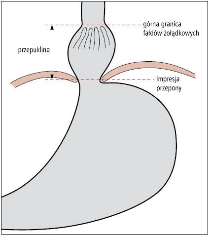 Pacjent z przepukliną wślizgową rozworu przełykowego i niedokrwistością