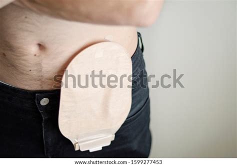 Front View On Colostomy Bag Attached Foto De Stock