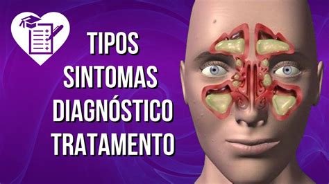 Sinusite Causas Sintomas E Tratamento Verloop Io