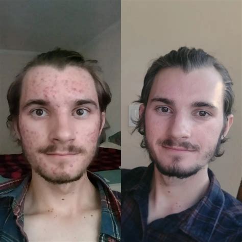 One year ago I had no hope, now I'm free from those chains--time heals