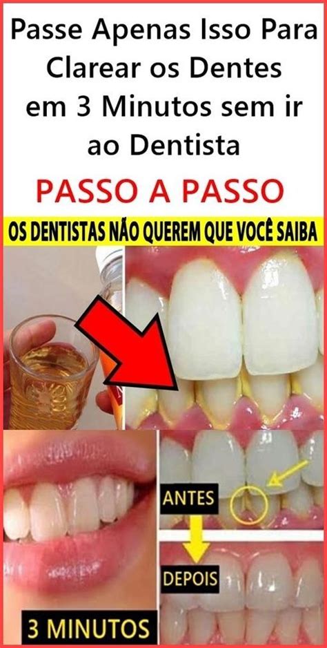 Em Minutos Remova O Ac Mulo De Placa Bacteriana E T Rtaro Nos Dentes