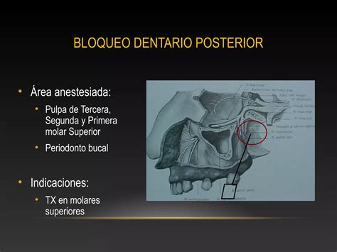 Técnicas de anestesia en maxilar superior PPT