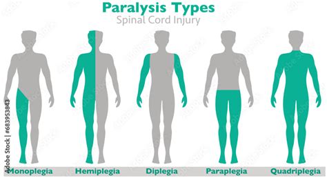 Paralysis types, palsy, spinal cord injury. Hemiplegia, diplegia ...